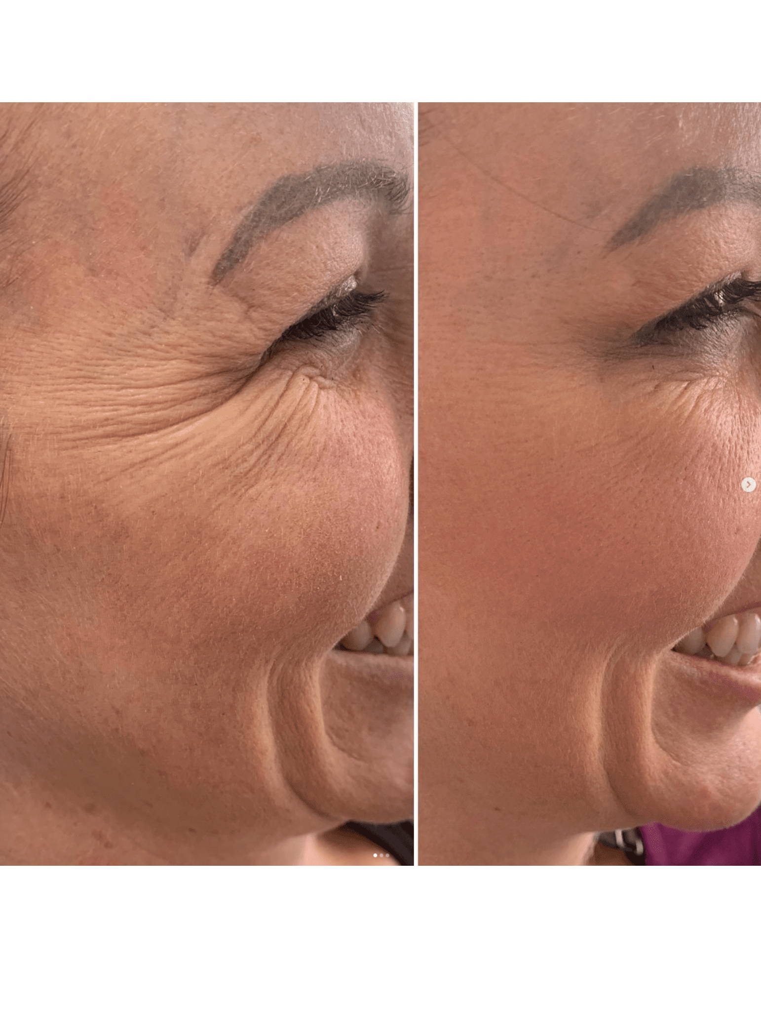 Botox results female eye area Anti-wrinkle injection results female eye area