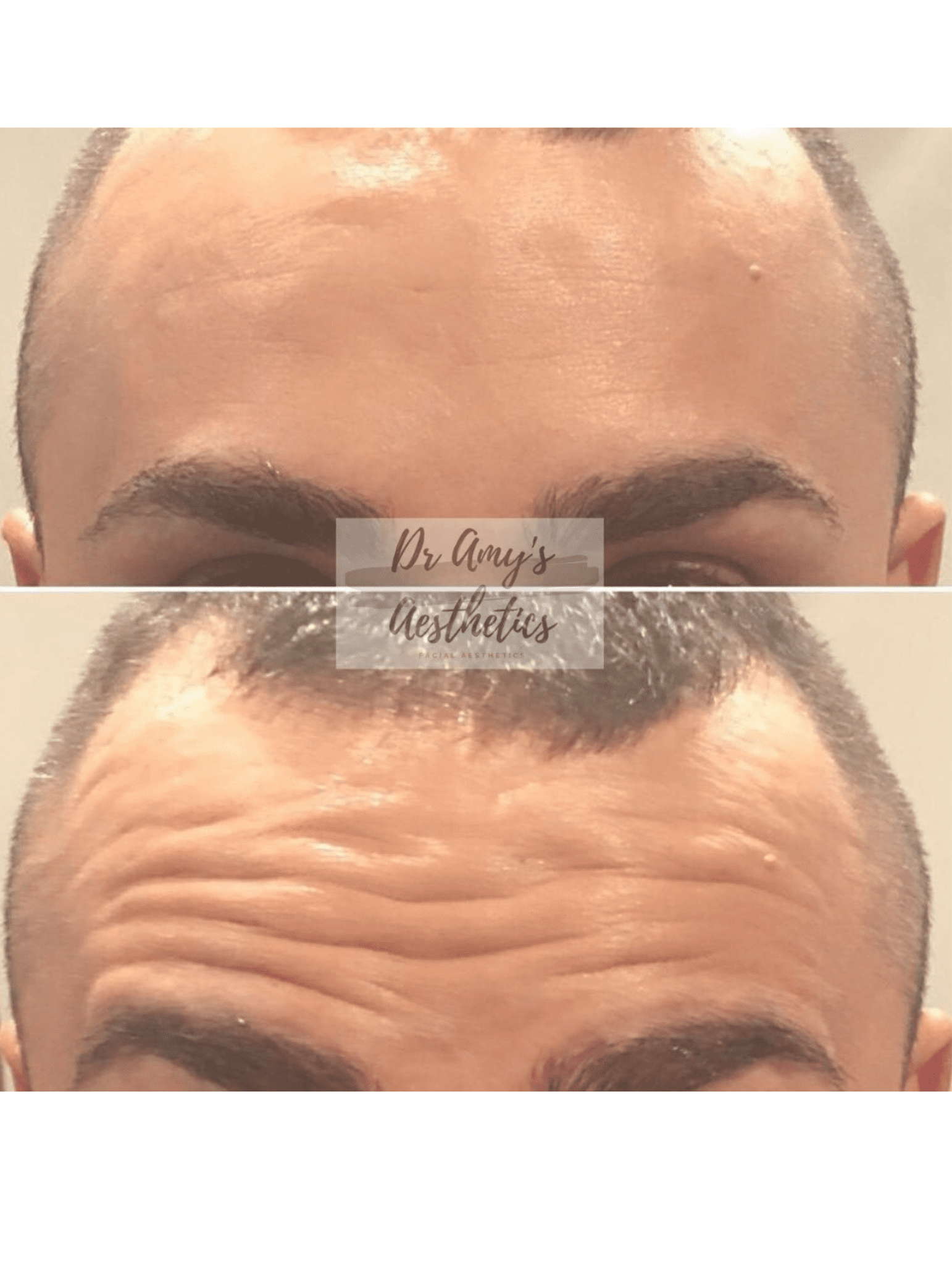 Botox results male forehead Anti-wrinkle injection results male forehead